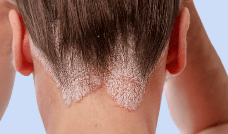 Service Provider of Psoriasis Ayurvedic Treatment in New Delhi, Delhi, India.