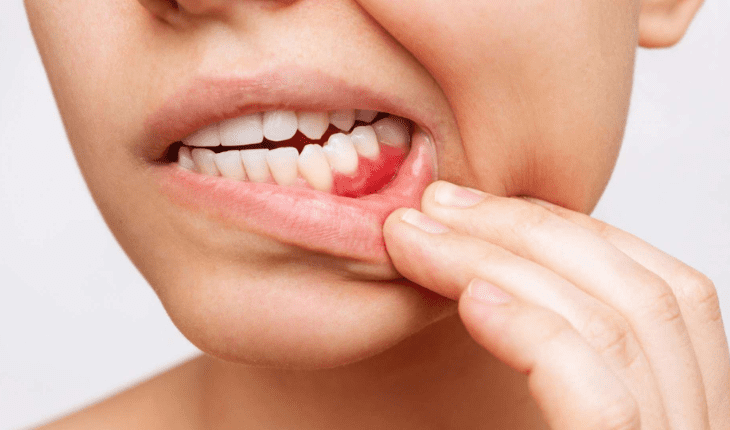 Service Provider of Bleeding Gums Ayurvedic Treatment in New Delhi, Delhi, India.
