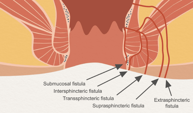 Service Provider of Anal Fistula Ayurvedic Treatment in New Delhi, Delhi, India.