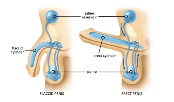 Service Provider of Erectile Dysfunction Ayurvedic Treatment in New Delhi, Delhi, India.