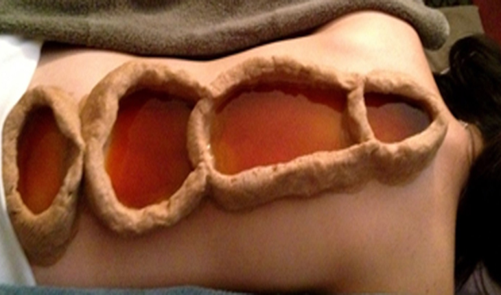 Service Provider of Spine Basti Ayurvedic Treatment in New Delhi, Delhi, India.