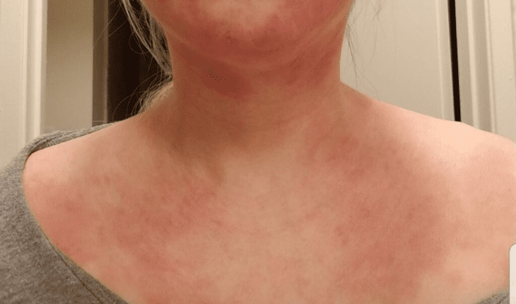 Service Provider of Eczema Ayurvedic Treatment in New Delhi, Delhi, India.