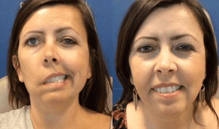 Service Provider of Facial Palsy Ayurvedic Treatment in New Delhi, Delhi, India.