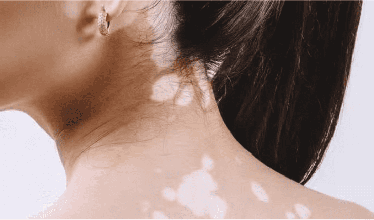 Service Provider of Vitiligo / Leucoderma Ayurvedic Treatment in New Delhi, Delhi, India.