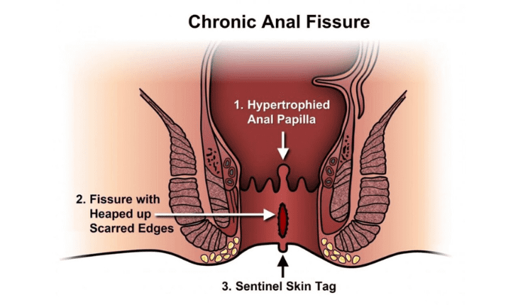 Service Provider of Anal Fissure Ayurvedic Treatment in New Delhi, Delhi, India.