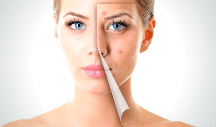 Service Provider of Acne & Pimples Ayurvedic Treatment in New Delhi, Delhi, India.