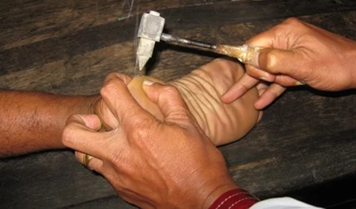 Service Provider of Agnikarmam Ayurvedic Treatment in New Delhi, Delhi, India.