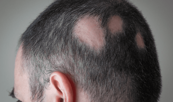 Service Provider of Alopecia Areata Ayurvedic Treatment in New Delhi, Delhi, India.