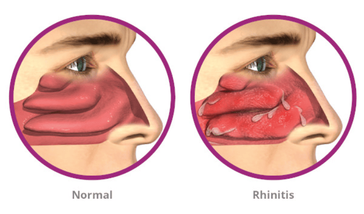 Service Provider of Rhinitis Ayurvedic Treatment in New Delhi, Delhi, India.